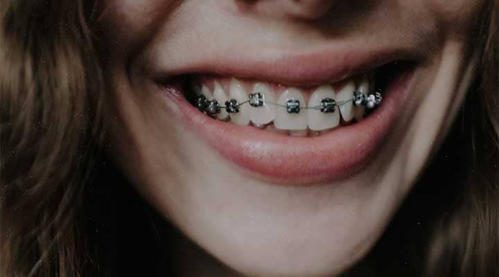 aparat dentar metalic fix, ortodontie Targu Mures