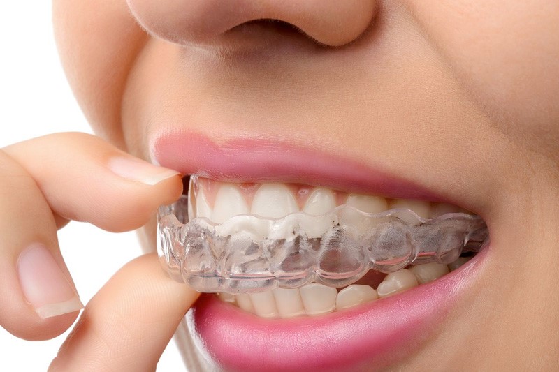 aparat dentar Targu Mures, ortodontie